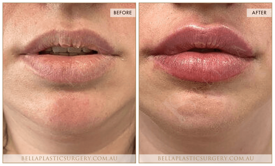 Non-Surgical BA Images, Bella Plastic Surgery