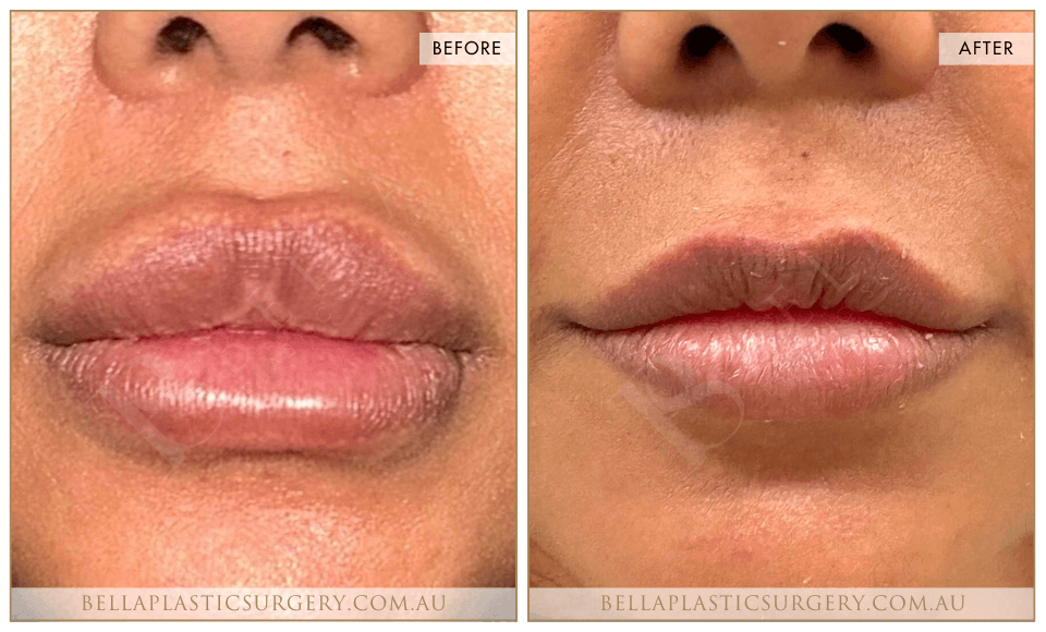 Non-Surgical BA Images, Bella Plastic Surgery