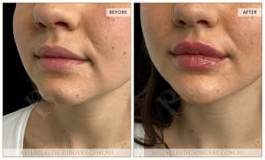 Lower Face Treatment 01 - 2