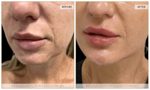Lower Face Treatment 02 - 3