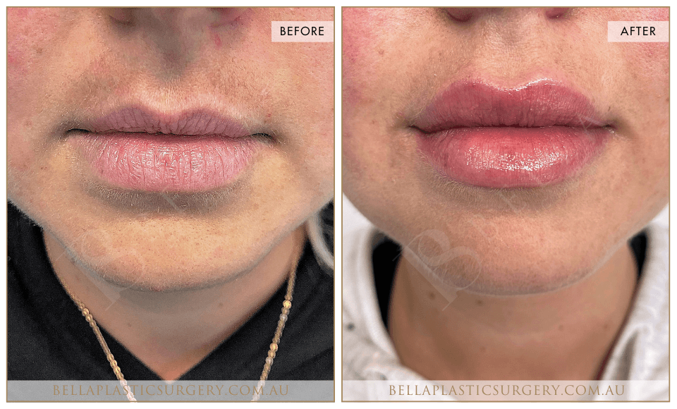 Non-Surgical BA Images, Bella Plastic Surgery