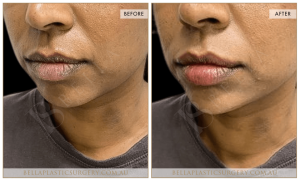Lower Face Treatment 04 - 5