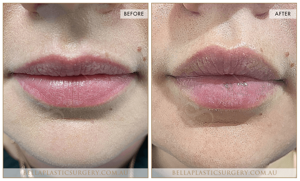 Non-Surgical BA Images, Bella Plastic Surgery