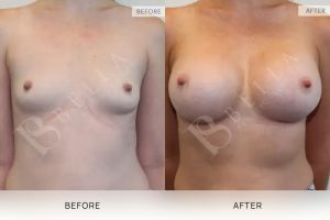 Breast Augmentation 14 - 13