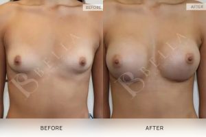 Breast Augmentation 18 - 17
