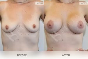 Breast Lift (Mastopexy) + Implants Patient 02 - 2