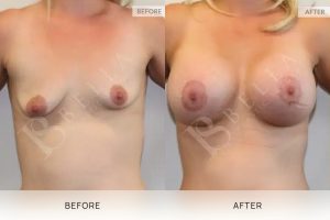 Breast Lift (Mastopexy) + Implants Patient 03 - 3