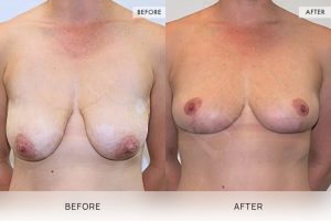 Breast Lift Patient 02 - 3