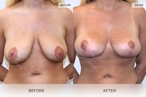 Breast Lift Patient 03 - 4