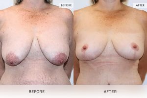 Breast Lift Patient 05 - 6