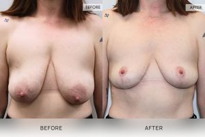 Breast Lift Patient 06 - 7