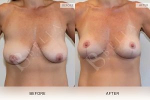 Breast Lift Patient 09 - 10