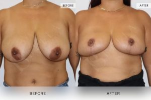 Breast Reduction Patient 04 - 5