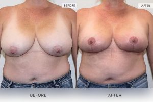 Breast Reduction Patient 06 - 7