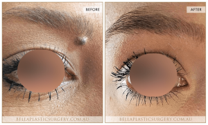 Laser Mole Removal 01 - 2
