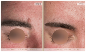 Laser Mole Removal 04 - 5