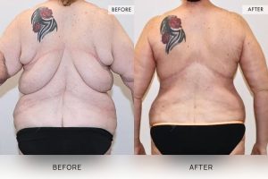 Bra Lipectomy Patient 02 - 3