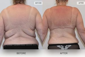 Bra Lipectomy Patient 03 - 4