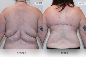 Bra Lipectomy Patient 08 - 9