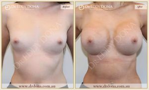Breast Augmentation 01 - 1