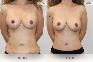 Post-Pregnancy Surgery Patient 01 - 2