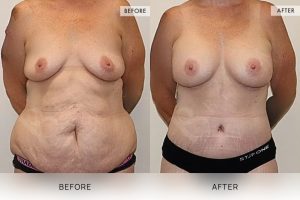 Post-Pregnancy Surgery Patient 11 - 12