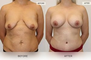 Post-Pregnancy Surgery Patient 13 - 14
