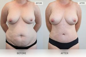 Post-Pregnancy Surgery Patient 14 - 15