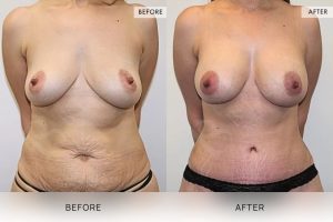 Post-Pregnancy Surgery Patient 16 - 17