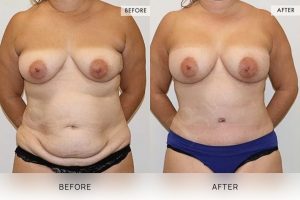 Post-Pregnancy Surgery Patient 19 - 20