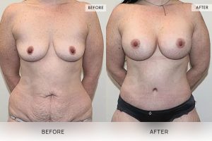 Post-Pregnancy Surgery Patient 02 - 3
