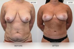 Post-Pregnancy Surgery Patient 21 - 22