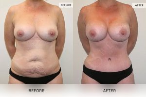 Post-Pregnancy Surgery Patient 03 - 4