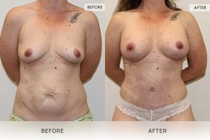 Post-Pregnancy Surgery Patient 05 - 6