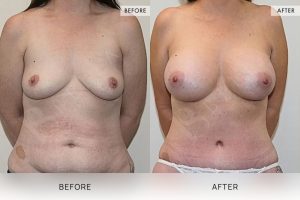 Post-Pregnancy Surgery Patient 06 - 7