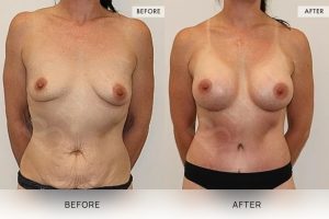 Post-Pregnancy Surgery Patient 08 - 9