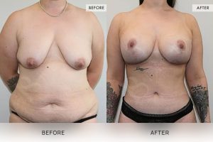 Post-Weight Loss Body Contouring Patient 01 - 2