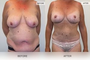 Post-Weight Loss Body Contouring Patient 10 - 11