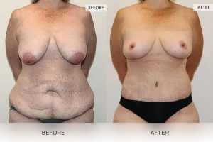 Post-Weight Loss Body Contouring Patient 02 - 3