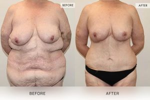 Post-Weight Loss Body Contouring Patient 03 - 4