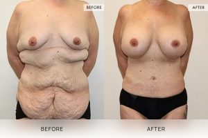 Post-Weight Loss Body Contouring Patient 04 - 5