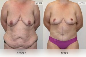 Post-Weight Loss Body Contouring Patient 05 - 6