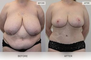 Post-Weight Loss Body Contouring Patient 06 - 7
