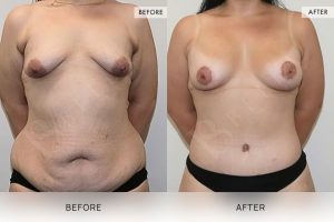 Post-Weight Loss Body Contouring Patient 07 - 8