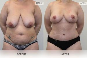 Post-Weight Loss Body Contouring Patient 08 - 9