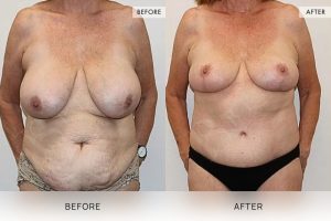 Post-Weight Loss Body Contouring Patient 09 - 10