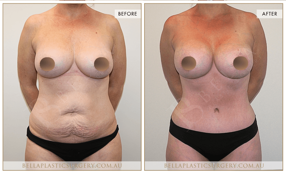 Surgical BA Images, Bella Plastic Surgery