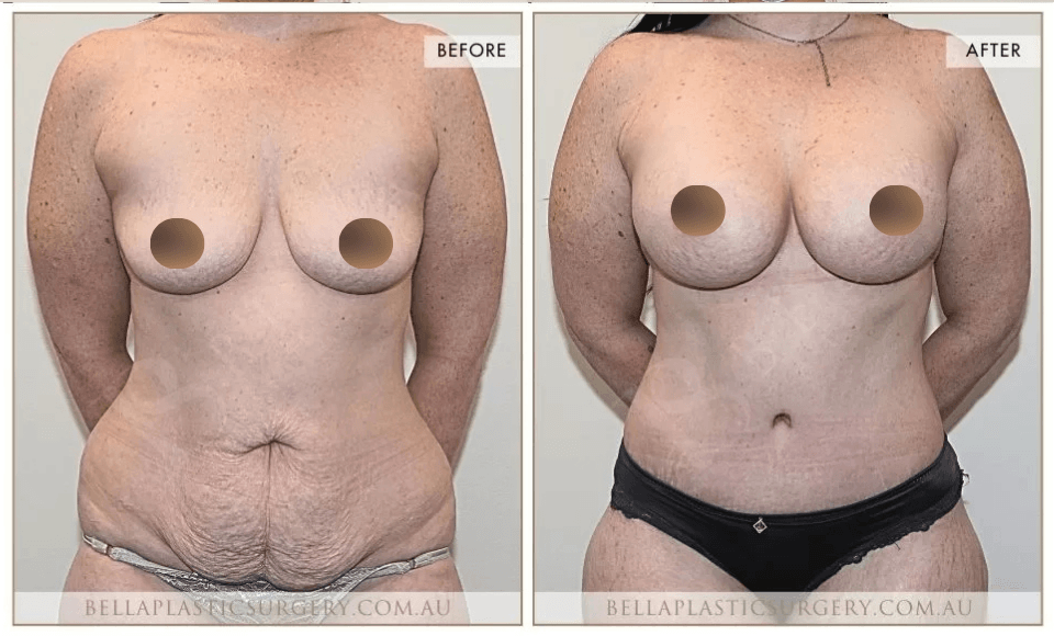 Surgical BA Images, Bella Plastic Surgery