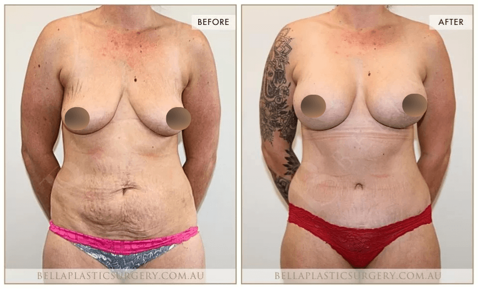 Surgical BA Images, Bella Plastic Surgery