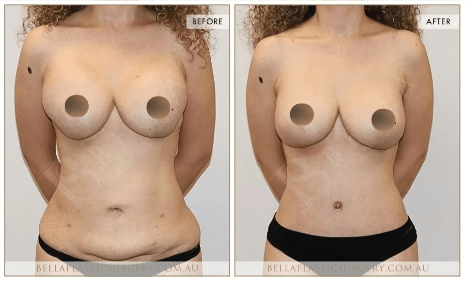 Surgical BA Images, Bella Plastic Surgery